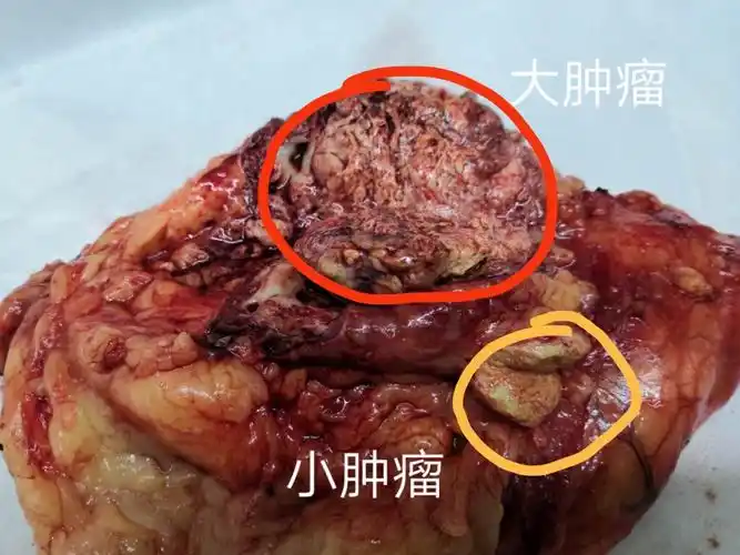一个肾长2个恶性肿瘤 - 好大夫在线