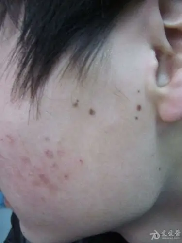 青年身上的黑痣——色素痣