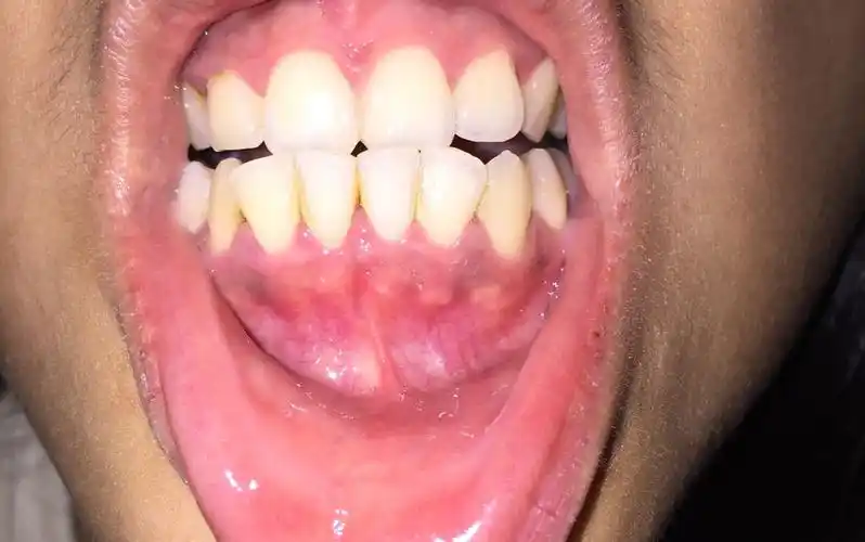 我这是牙龈萎缩吗?能看到牙齿内侧有黄色的牙结石,怎么办?