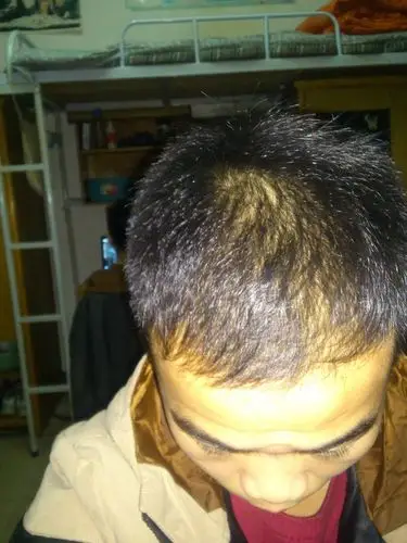 脂溢性,肾阴虚脱发能治好吗.我的症状属于那种脱发呢