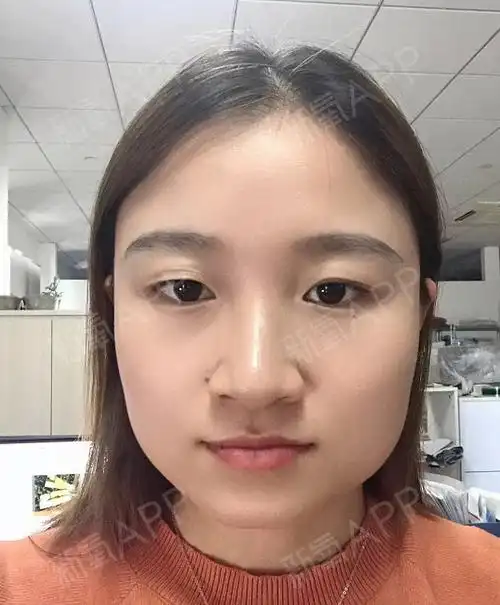 国字脸,大咬肌瘦脸针,瘦咬肌,改善面部轮廓清晰度 _圈子-新氧美容整形