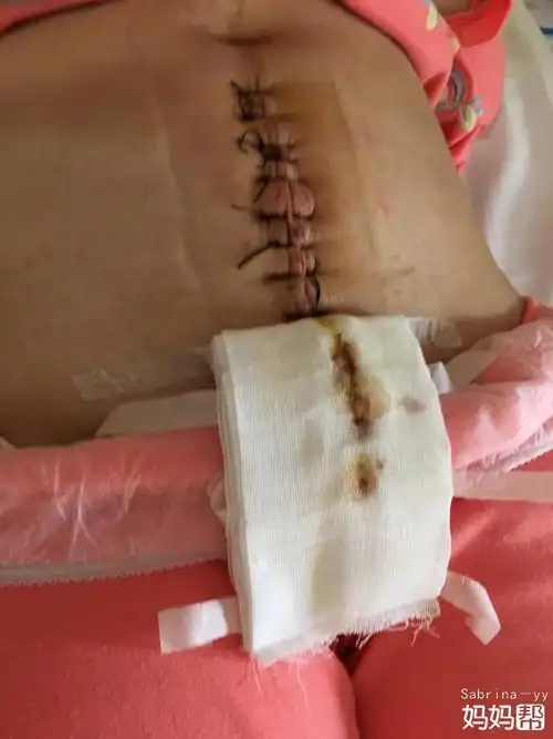 等到伤口愈合后,再次进行肢体扩展更大的行动如果是横向切口,手术后5