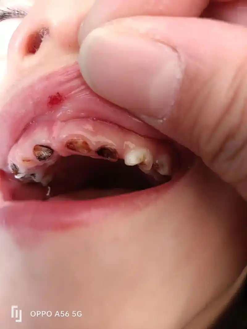 一岁就开始这样了.# 智齿拔除 # 掉牙齿的小朋友 # 原谅 - 抖音