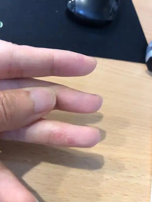 冷冻去疣第16天