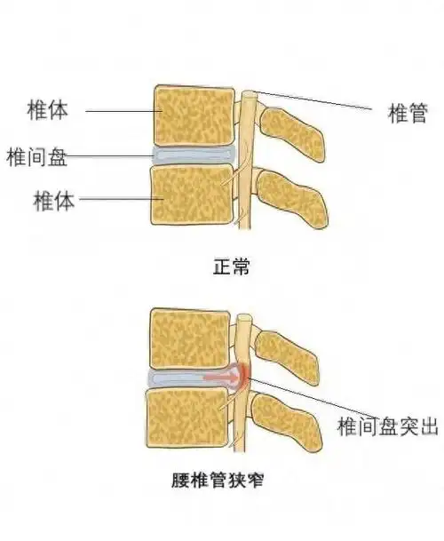 一次查出两种病腰椎间盘突出症和腰椎管狭窄到底有没有关系
