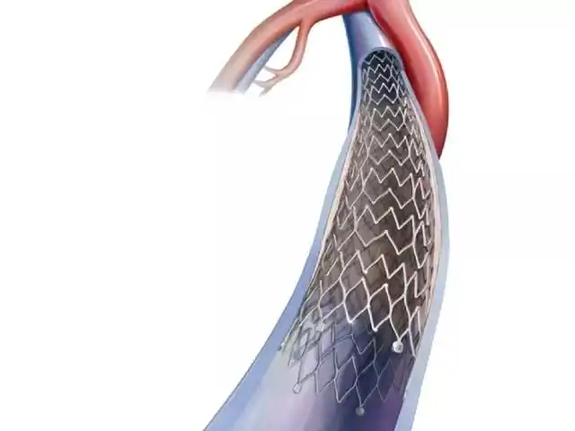 支架venovo,这是继中国首个球囊扩张式血管覆膜支架lifestream之后,又