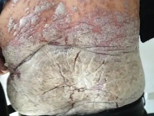 肚子上长癣图片黑褐色爆皮