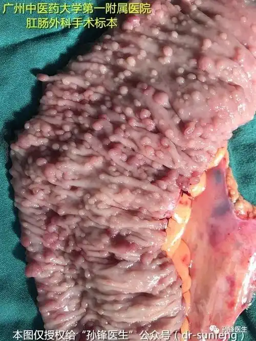 医学科普|一篇文章讲清楚:家族性腺瘤性息肉病(附15张精美图片)