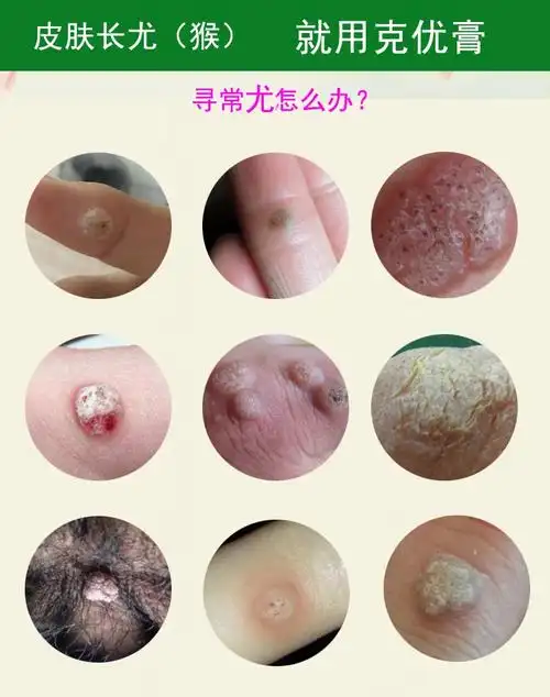 克优膏平灵液霜疣瘊平尖锐湿疣脖子腋下丝状忧疣肉疙瘩皮赘跖忧瘊肉子