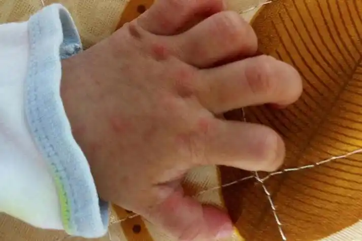 手足口病手部疱疹图