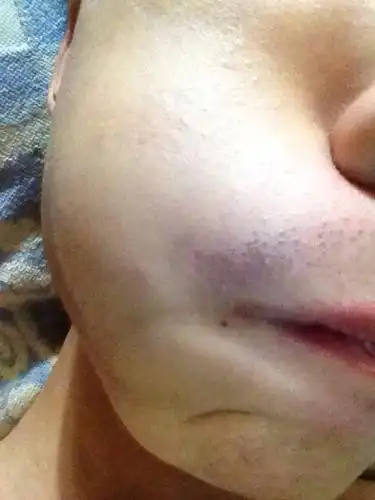 胡子已经刮不干净了本人二十岁刮完毛囊是黑的也就是胡须根部太粗了