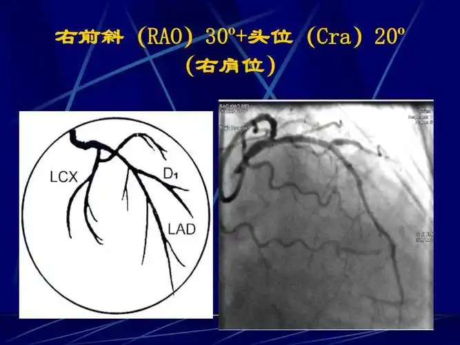 冠脉造影术简装板-绝好资料ppt