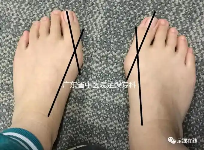 微提醒小孩走路容易疲劳小心是这个病惹的祸