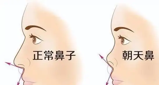 鼻子塌不算什么鼻孔外露才拉垮显老又显凶太多人遭殃