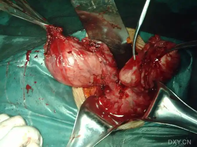 【图片】双子宫切除术图片