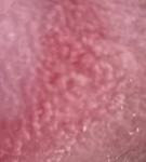 假性湿疣和尖锐湿疣的区别: 假性湿疣一般是对称分布的,两侧都是鱼子