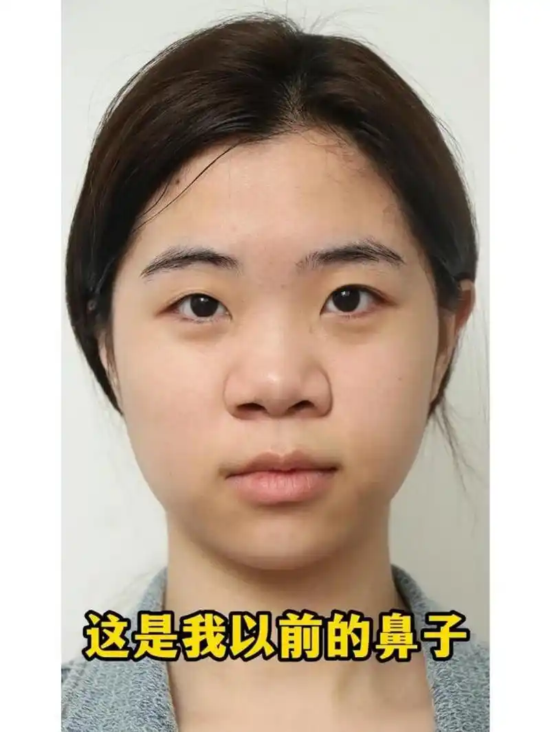 以前的鼻子:鼻小02柱短而偏曲02鼻宽02鼻梁粗大02鼻子扁平不