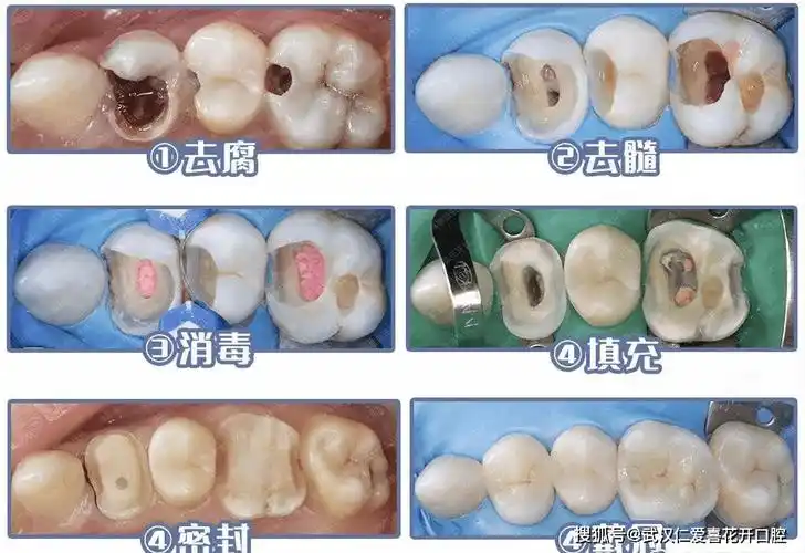 所以医生建议你做完根管治疗后戴牙冠,那一定是为了你的牙齿好.