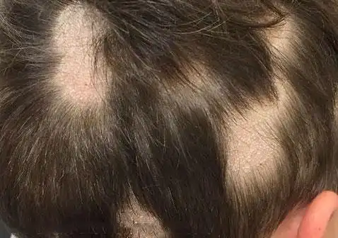 儿童头皮真菌感染图片2