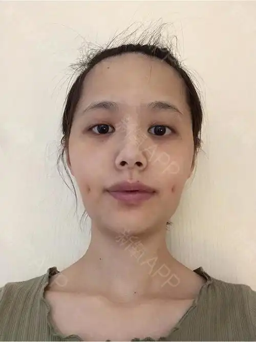 很喜欢佟丽娅的小梨涡,浅浅的但又很特别,知道可以人_圈子-新氧美容