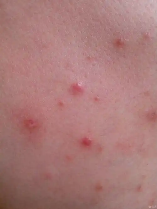 还有一例胸前丘疹的