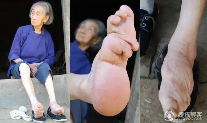 女孩子从五,六岁开始,用一条10公分宽,三尺多长的裹脚布,把脚趾骨紧紧
