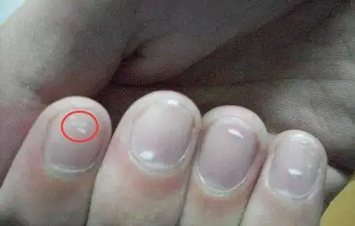 手脚若出现4种"异常",或是"癌细胞"已泛滥