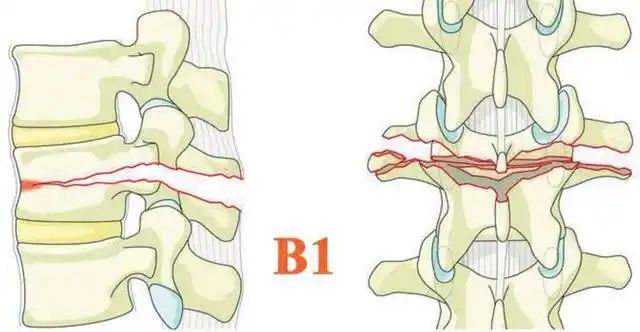 胸腰椎损伤,青年人是该病的高发人群,男性致伤人数高于女性