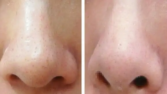 收缩毛孔前后对比图面对粗大的毛孔以及黑头,你是否也还在用手挤,用