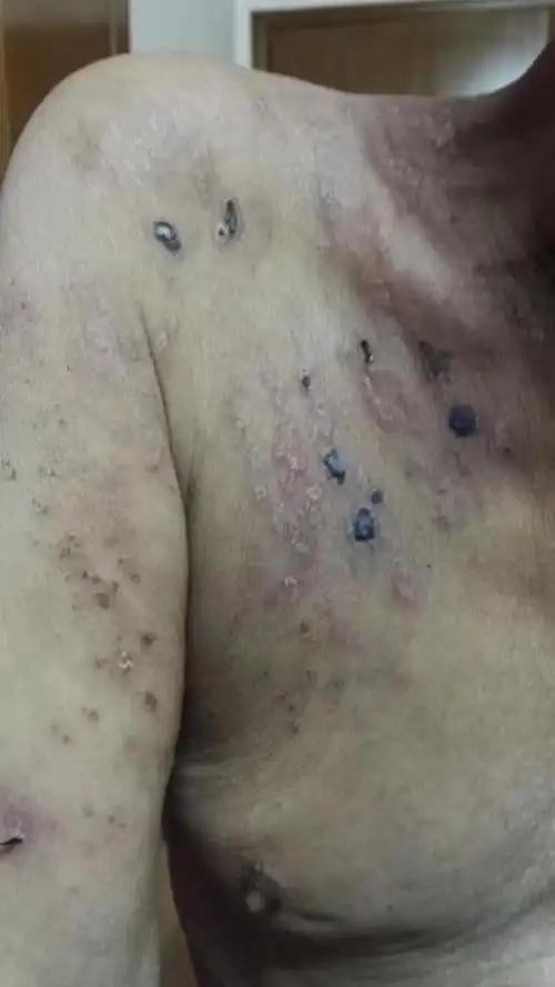 中草外用让带状疱疹(飞蛇)快速闪退