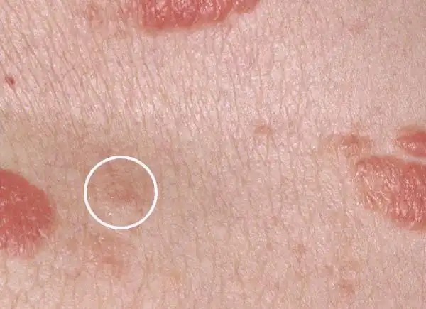 mf(斑片与斑块期)及斑片期mf的诊断线索 - 皮肤与性传播疾病讨论版