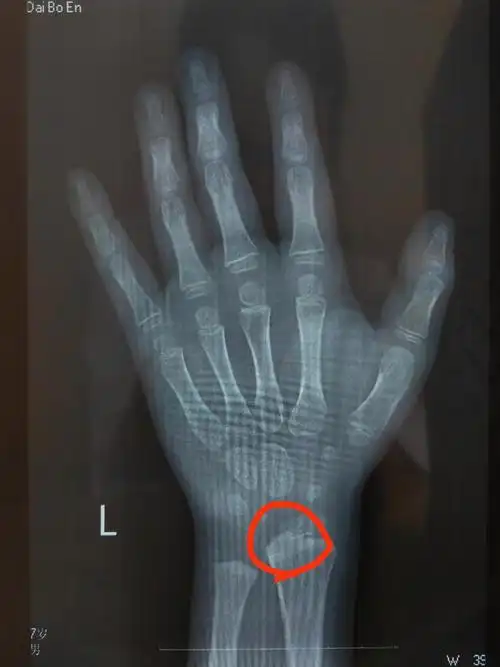 年龄只有看骨龄才能确定孩子现在的发育状态只有看骨龄才能知道孩子