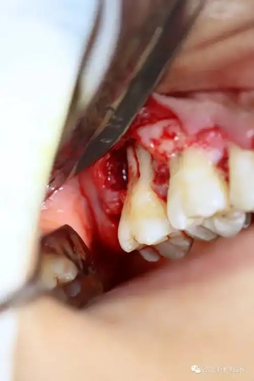 病例分享牙周牙髓联合病变治疗一例