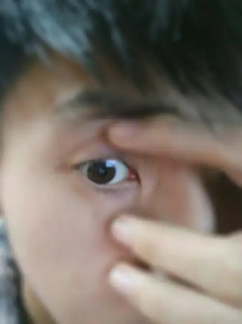 右侧眼睛内眼角,就是靠近鼻梁的眼角,眼睛里长了快肉,朋友说是眼息肉