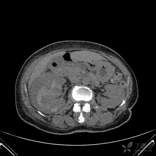 肾包膜下血肿?脓肿?其他?