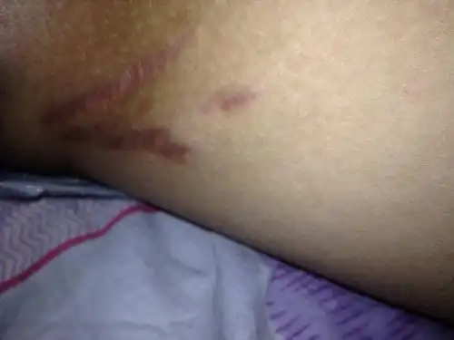 大腿内侧长得是什么了不