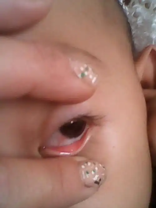 为您推荐: 其他回答 宝宝的情况积极的建议到医院眼科检查是否结膜炎