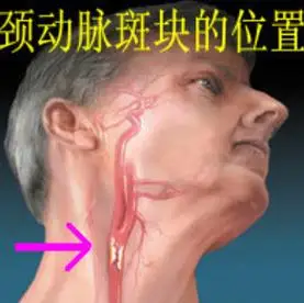 颈动脉一旦堵住,中风脑梗随之而来!医生:2种食材,避开无形杀手