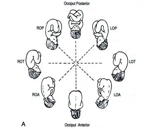 胎位臀位lst是什么意思