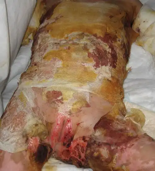 二级烫伤后恢复的图片_有来医生