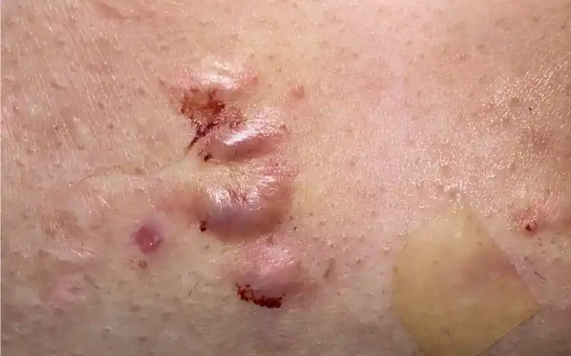 王小花瘢痕疙瘩治疗分享复发率极高的痘疤增生