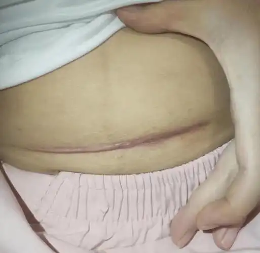 剖腹产疤痕增生又丑又痒?掌握这几招,60天轻松淡疤不复发!