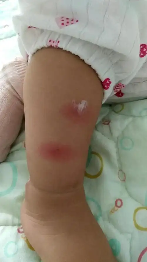 小孩一个腿上四五个大疙瘩还红肿,一开始只有一个以为是咬的,后来连着
