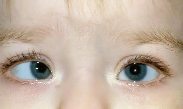 孩子黑眼珠"消失"!只因这种新兴玩具!医生:难恢复