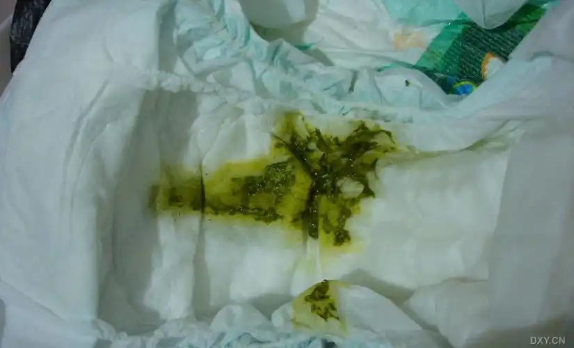 【求助】74天婴儿,大便呈绿色,精神状态正常,母乳喂养