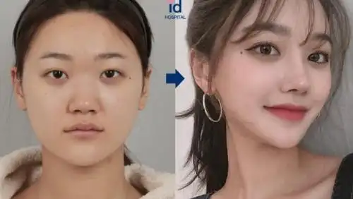 韩国id眼综合整形前后对比照片