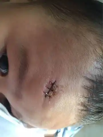 伤口还有点点肿. 今天是第八天了 昨天去医院 医生