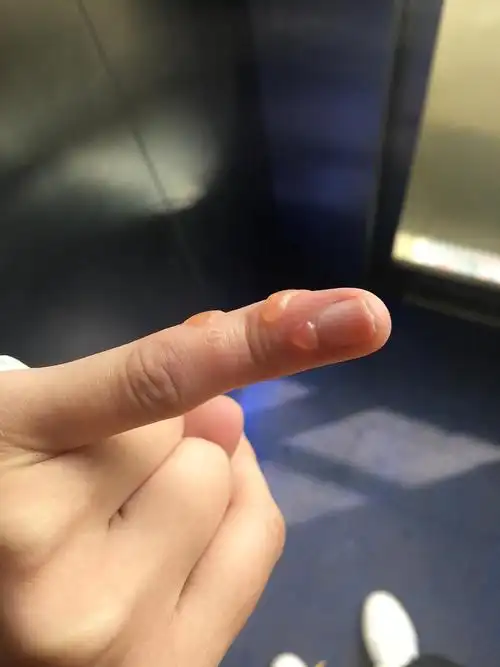 求问大家手指会突然长水泡吗(有图慎入