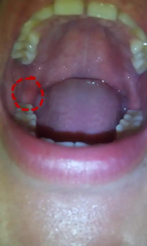 口腔里肿痛明显红肿起来咀嚼吞咽东西时