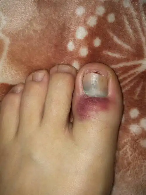 我的脚被砸伤了有淤血,怎么办